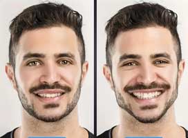 فرم دهنده و ماساژور برای تقویت صورت
